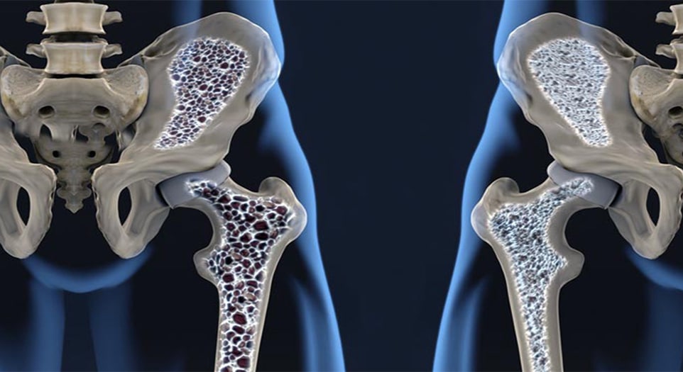 Osteoporose em quadril Dr. Marcelo Corrêa reumatologista Tratamentos Reumatológicos