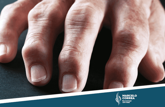 mão com artrite reumatóide - site Dr. Marcelo Corrêa