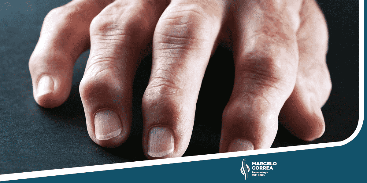 mão com artrite reumatóide - site Dr. Marcelo Corrêa