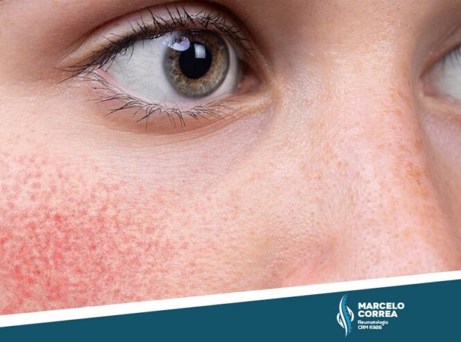parte de rosto de mulher com lúpus eritematoso sistêmico - Dr Marcelo Corrêa Reumatologista
