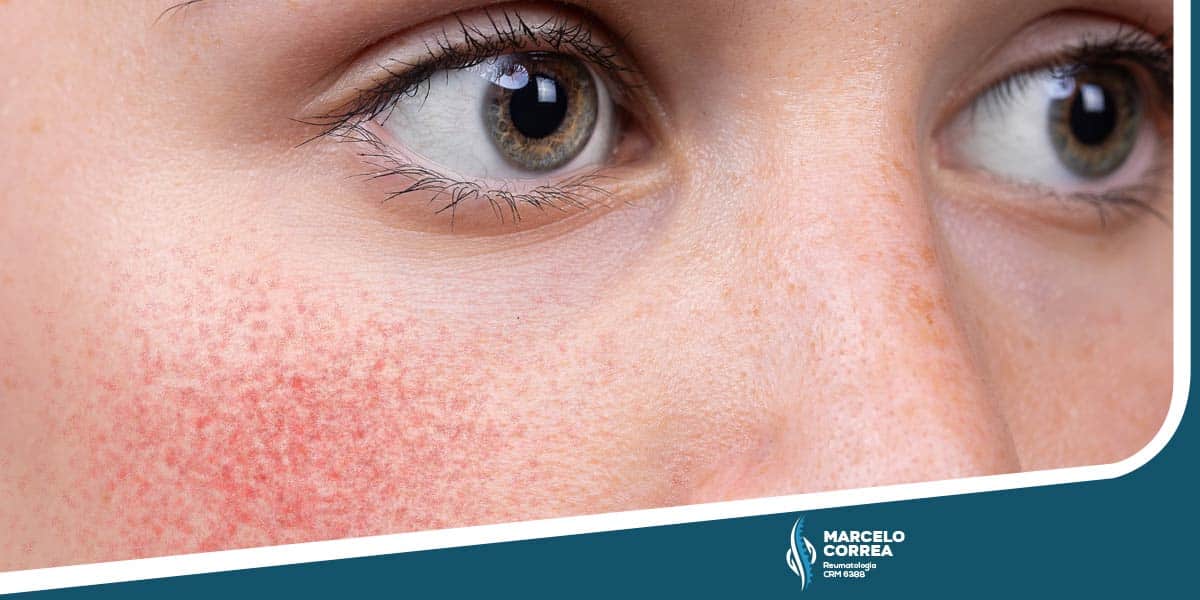 parte de rosto de mulher com lúpus eritematoso sistêmico - Dr Marcelo Corrêa Reumatologista