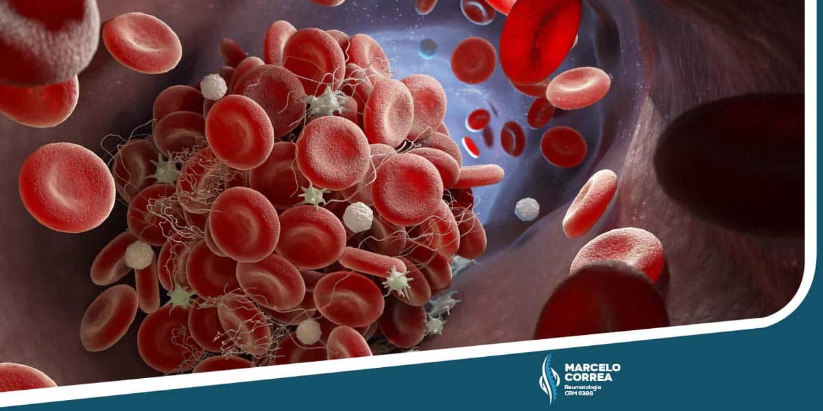 ilustração de células sanguíneas com síndrome antifosfolípide - Dr Marcelo Corrêa Reumatologista - site Dr. Marcelo Corrêa reumatologista