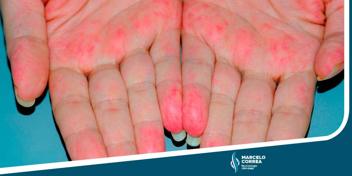 mão de mulher com manchas por ter vasculites - site Dr. Marcelo Corrêa reumatologista