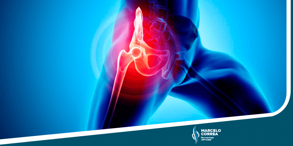 Osteoartrite: O Que é, Sintomas E Tratamento - Dr. Marcelo Corrêa Reumato