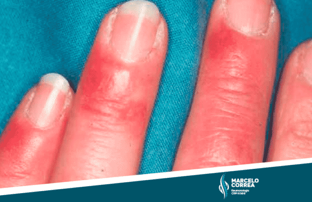 dedos da mão com sinais de esclerose sistêmica - site Dr. Marcelo Corrêa