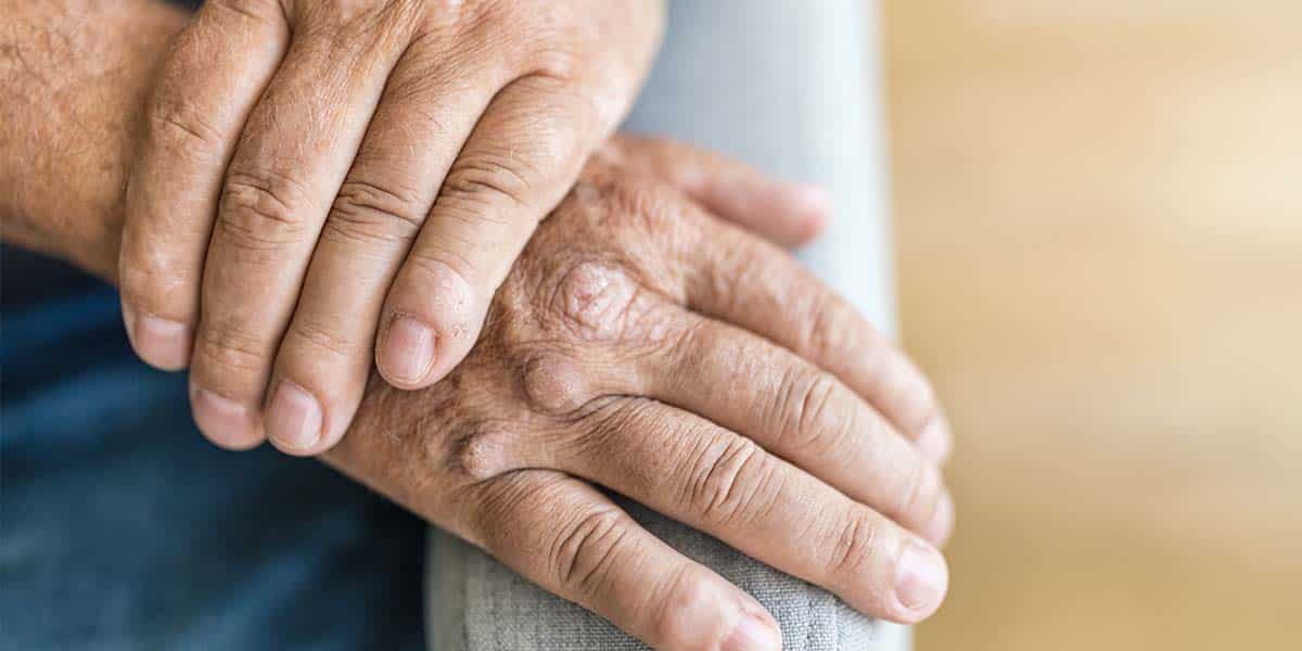 Mãos com inicio de uma doença autoimune - Dr. Marcelo José Uchoa Corrêa Reumatologista de Belém - PA