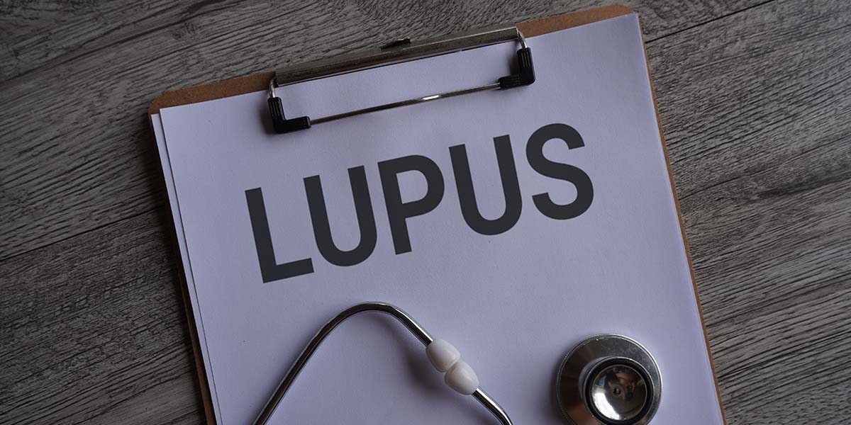 Lupus - Dr. Marcelo José Uchoa Corrêa Reumatologista de Belém - PA