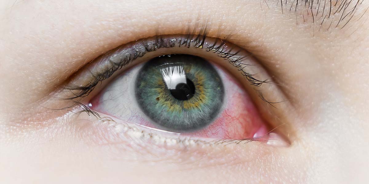 Vermelhidão no olho doença de Behçet - Dr. Marcelo José Uchoa Corrêa Reumatologista de Belém - PA